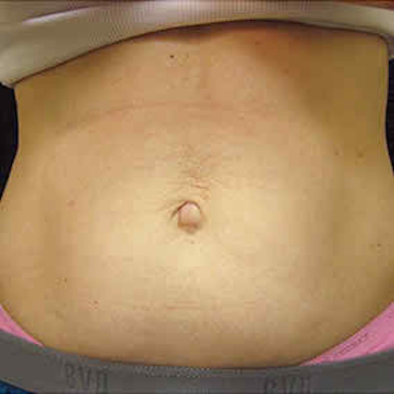 CoolSculpting Before & After Gallery - Patient 37499440 - Image 1