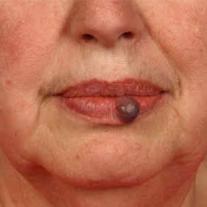 Facial Veins/Vascular Lesions Before & After Gallery - Patient 37499442 - Image 1
