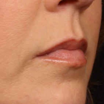 Cosmetic Filler Augmentation Before & After Gallery - Patient 37499441 - Image 1