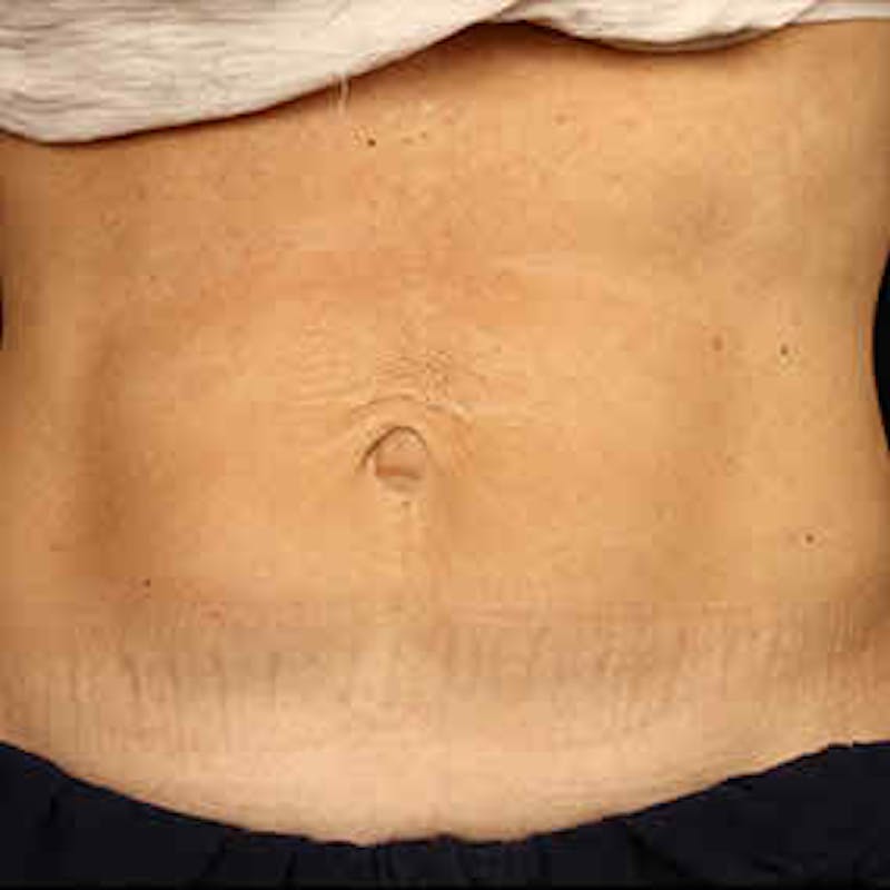 CoolSculpting Before & After Gallery - Patient 37499440 - Image 2