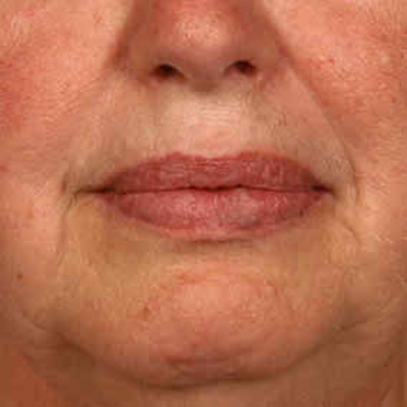 Facial Veins/Vascular Lesions Before & After Gallery - Patient 37499442 - Image 2