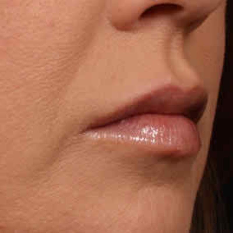 Cosmetic Filler Augmentation Before & After Gallery - Patient 37499441 - Image 2
