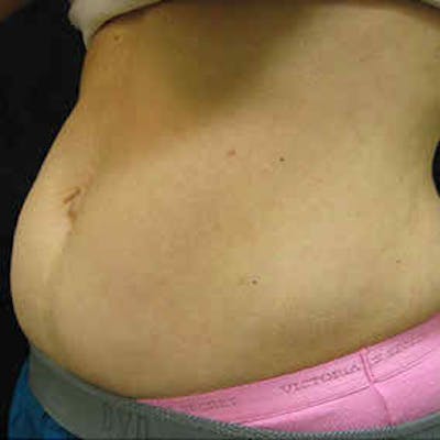 CoolSculpting Before & After Gallery - Patient 37499450 - Image 1