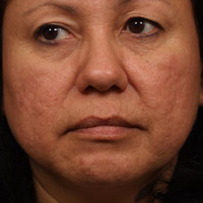 Cosmetic Filler Augmentation Before & After Gallery - Patient 37499451 - Image 1