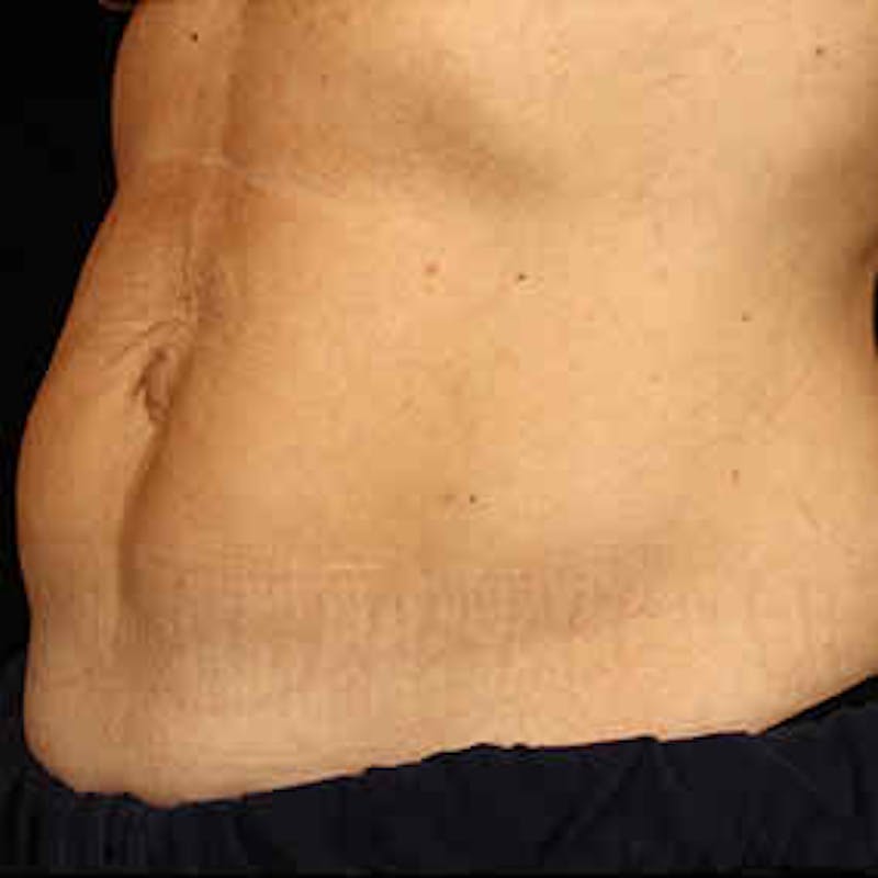 CoolSculpting Before & After Gallery - Patient 37499450 - Image 2
