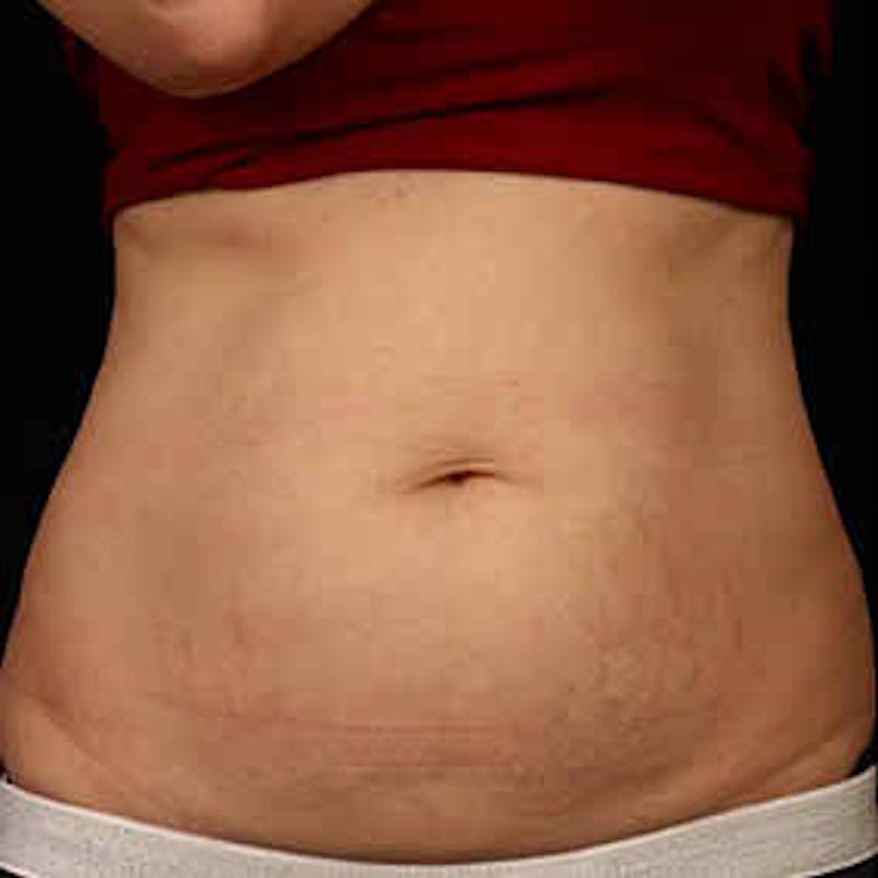 CoolSculpting Before & After Gallery - Patient 37499459 - Image 1