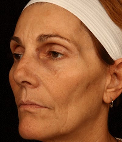Cosmetic Filler Augmentation Before & After Gallery - Patient 37499461 - Image 1