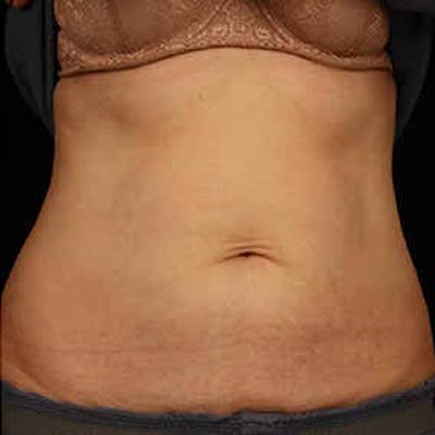 CoolSculpting Before & After Gallery - Patient 37499459 - Image 2