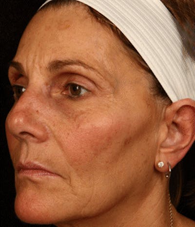 Cosmetic Filler Augmentation Before & After Gallery - Patient 37499461 - Image 2