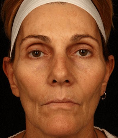 Cosmetic Filler Augmentation Before & After Gallery - Patient 37499470 - Image 1