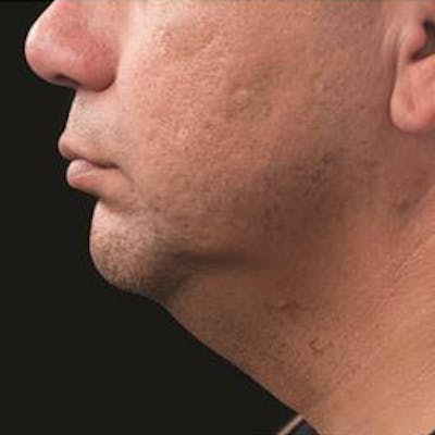 CoolSculpting Before & After Gallery - Patient 37499467 - Image 2