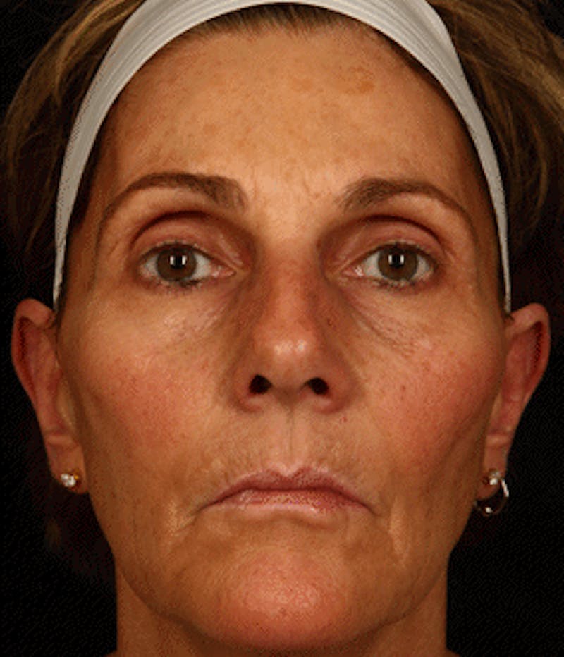 Cosmetic Filler Augmentation Before & After Gallery - Patient 37499470 - Image 2