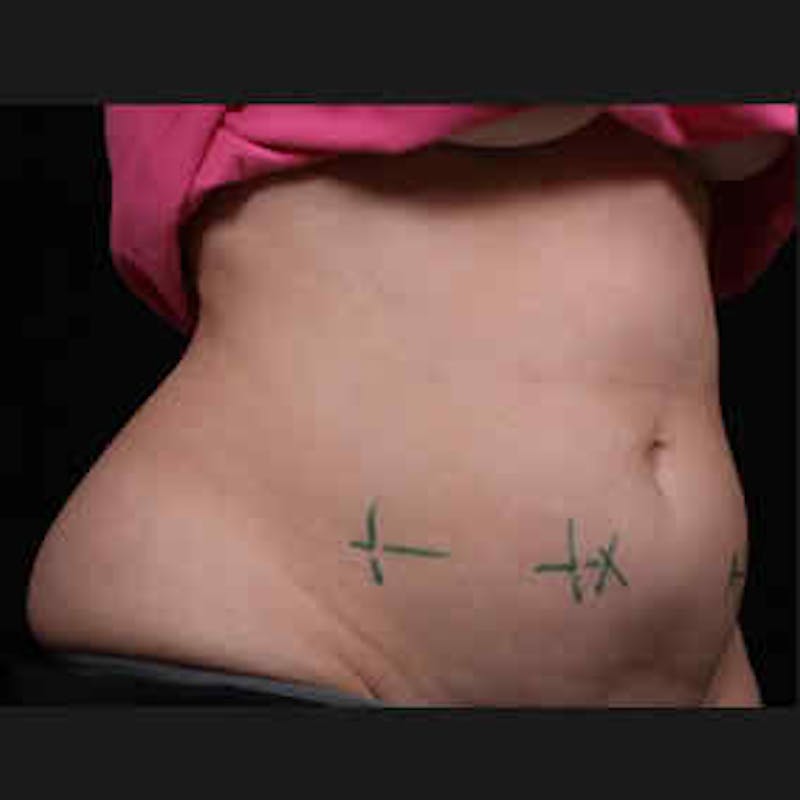 CoolSculpting Before & After Gallery - Patient 37499476 - Image 1