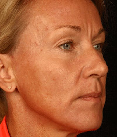 Cosmetic Filler Augmentation Before & After Gallery - Patient 37499479 - Image 1
