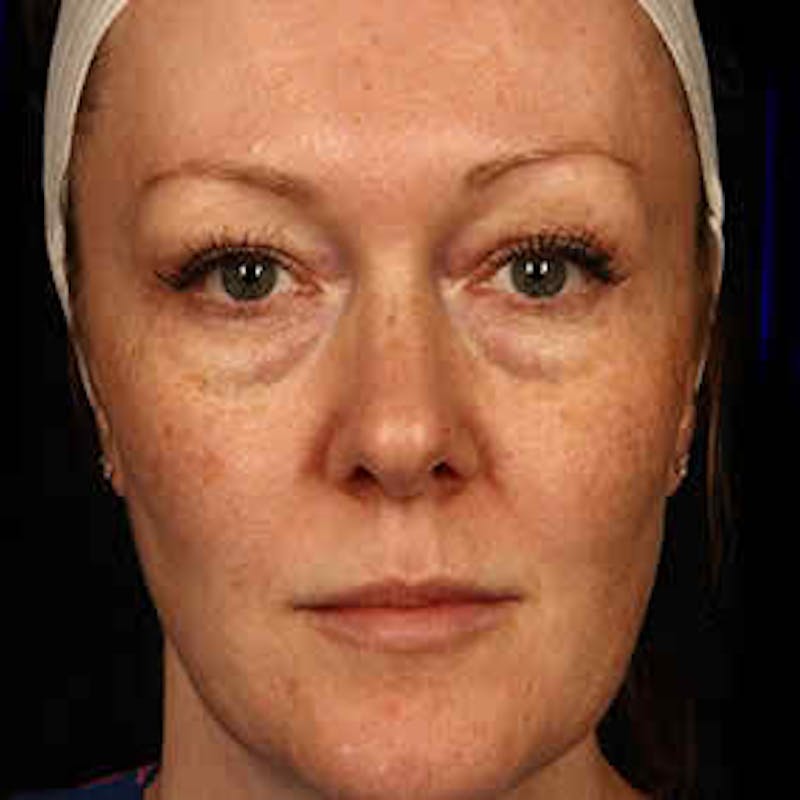 Fraxel Dual Before & After Gallery - Patient 37499480 - Image 1