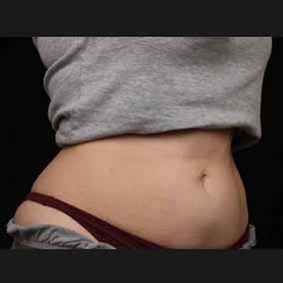 CoolSculpting Before & After Gallery - Patient 37499476 - Image 2