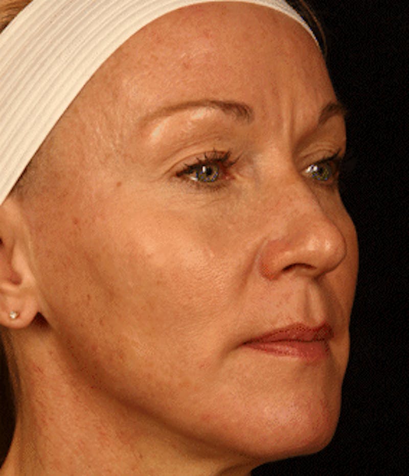 Cosmetic Filler Augmentation Before & After Gallery - Patient 37499479 - Image 2