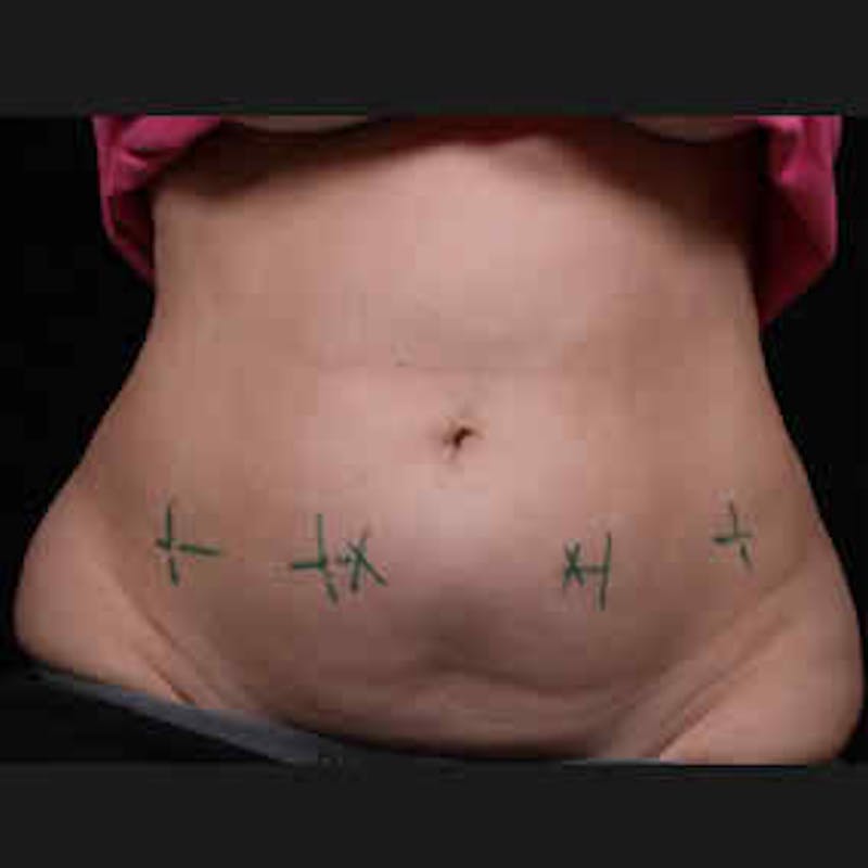CoolSculpting Before & After Gallery - Patient 37499489 - Image 1