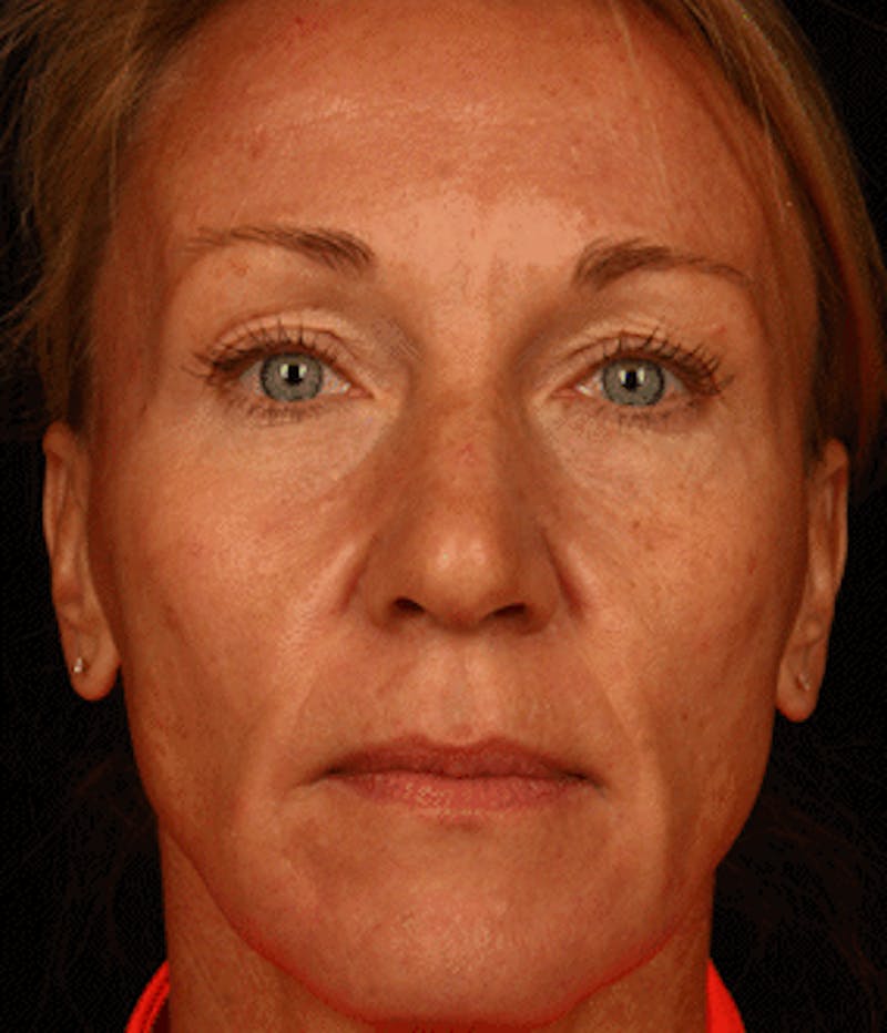 Cosmetic Filler Augmentation Before & After Gallery - Patient 37499494 - Image 1