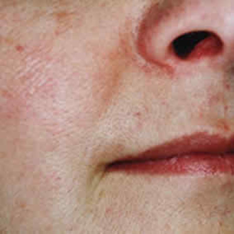Facial Veins/Vascular Lesions Before & After Gallery - Patient 37499487 - Image 2