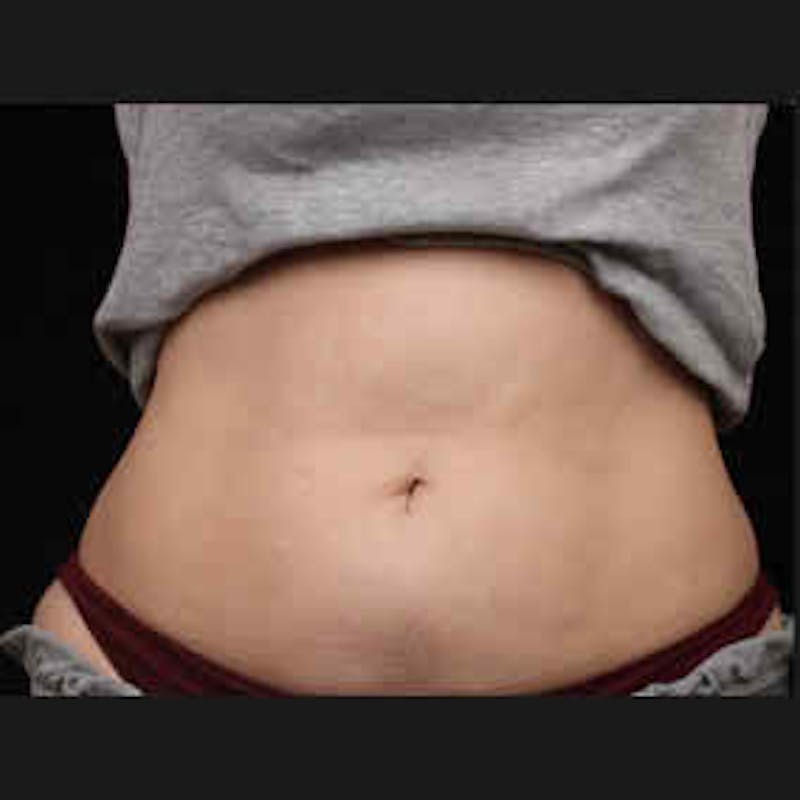 CoolSculpting Before & After Gallery - Patient 37499489 - Image 2