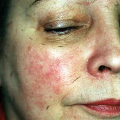 Facial Veins/Vascular Lesions Before & After Gallery - Patient 37499502 - Image 1