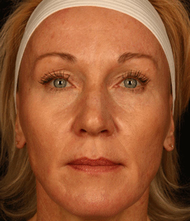 Cosmetic Filler Augmentation Before & After Gallery - Patient 37499494 - Image 2