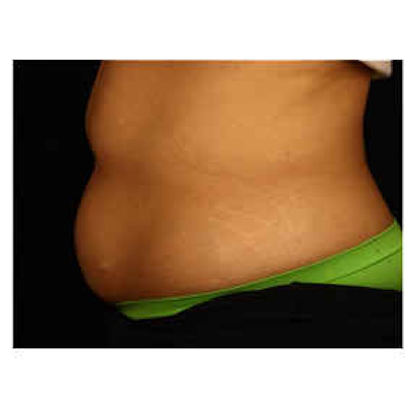 CoolSculpting Before & After Gallery - Patient 37499505 - Image 1