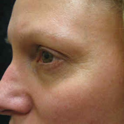 Fraxel Re:store™ Laser Rejuvenation Before & After Gallery - Patient 37499508 - Image 1