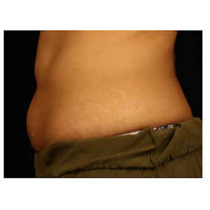 CoolSculpting Before & After Gallery - Patient 37499505 - Image 2