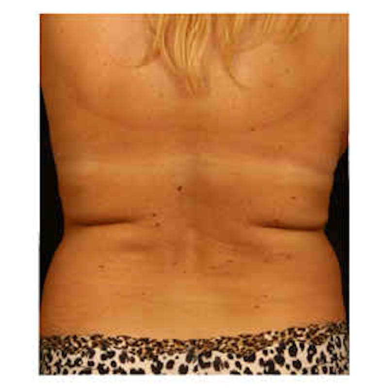 CoolSculpting Before & After Gallery - Patient 37499523 - Image 1