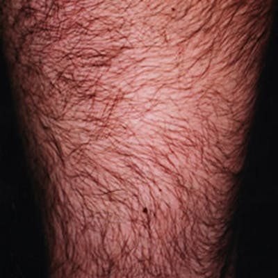 Laser Hair Removal Before & After Gallery - Patient 37499532 - Image 1