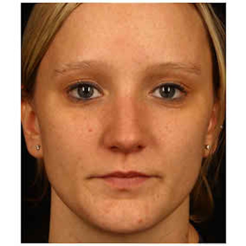 Cosmetic Filler Augmentation Before & After Gallery - Patient 37499530 - Image 1