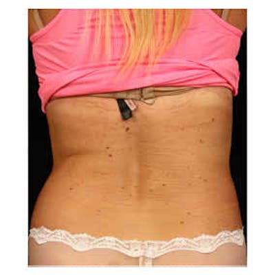 CoolSculpting Before & After Gallery - Patient 37499523 - Image 2