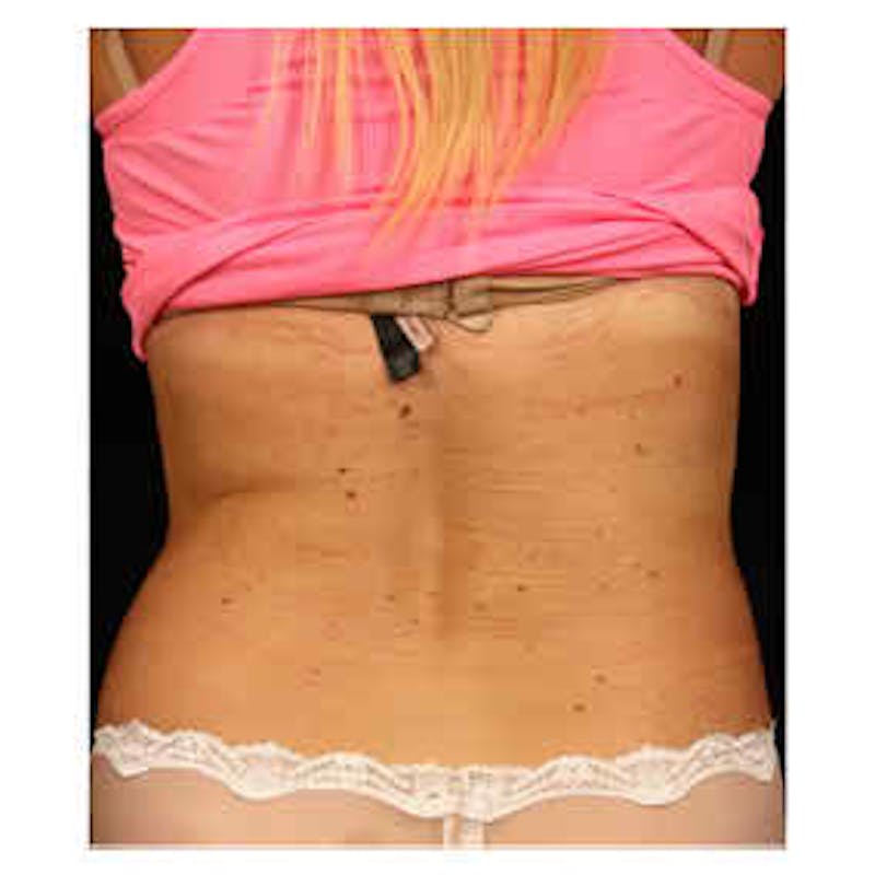 CoolSculpting Before & After Gallery - Patient 37499523 - Image 2