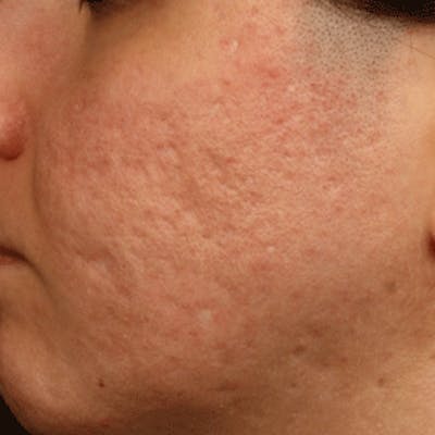 Fraxel Re:store™ Laser Rejuvenation Before & After Gallery - Patient 37499525 - Image 2