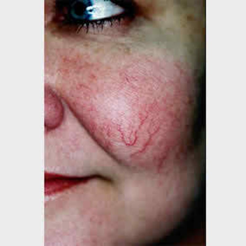Facial Veins/Vascular Lesions Before & After Gallery - Patient 37499536 - Image 1