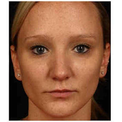 Cosmetic Filler Augmentation Before & After Gallery - Patient 37499530 - Image 2
