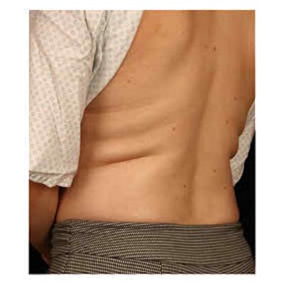 CoolSculpting Before & After Gallery - Patient 37499540 - Image 1