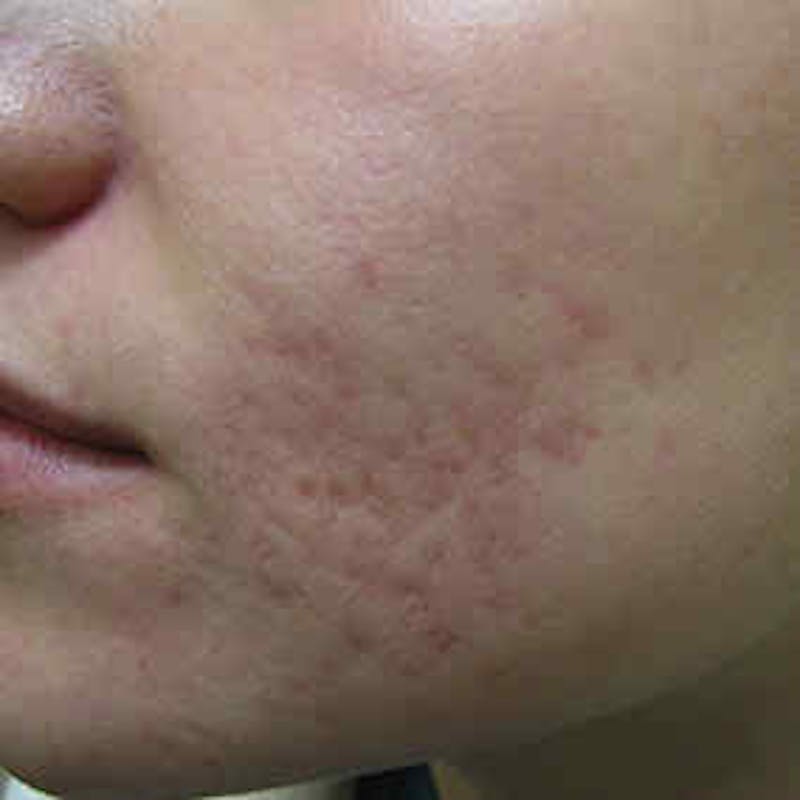 Fraxel Re:store™ Laser Rejuvenation Before & After Gallery - Patient 37499544 - Image 1