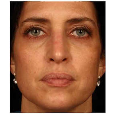Cosmetic Filler Augmentation Before & After Gallery - Patient 37499547 - Image 1