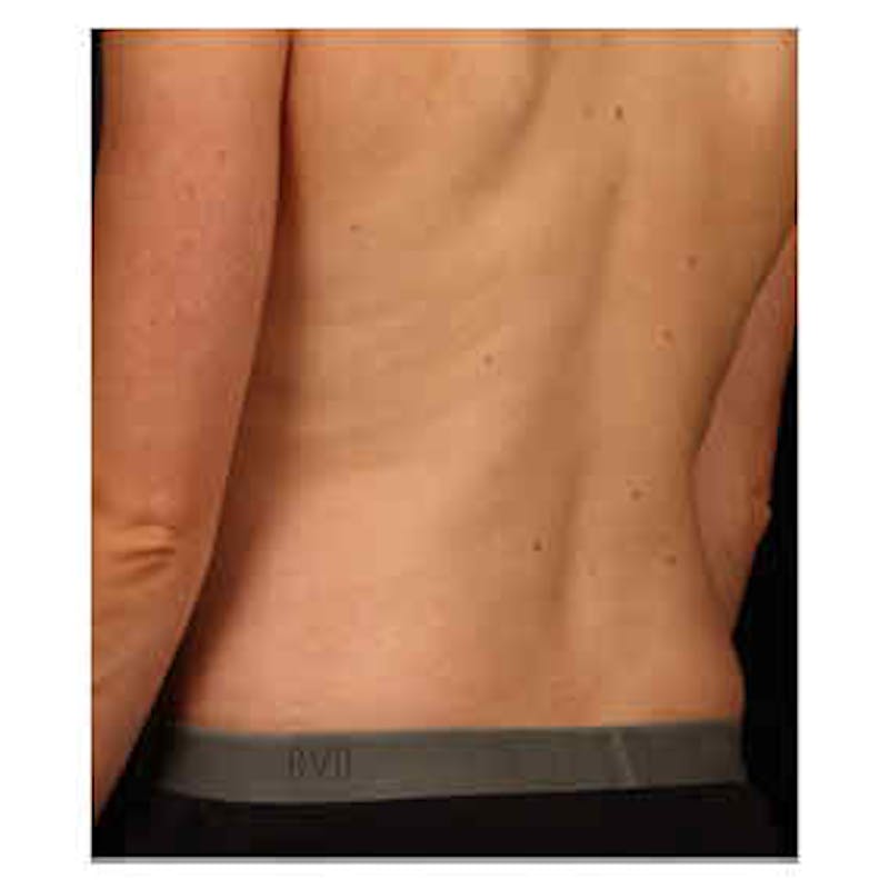 CoolSculpting Before & After Gallery - Patient 37499540 - Image 2