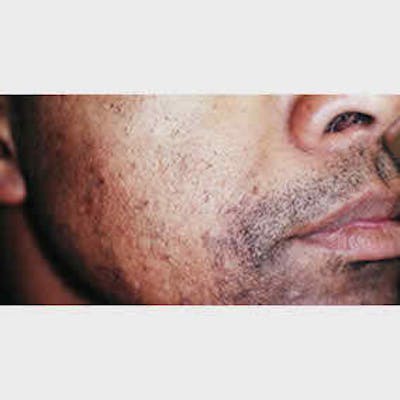 Laser Hair Removal Before & After Gallery - Patient 37499551 - Image 1