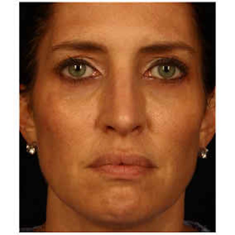 Cosmetic Filler Augmentation Before & After Gallery - Patient 37499547 - Image 2