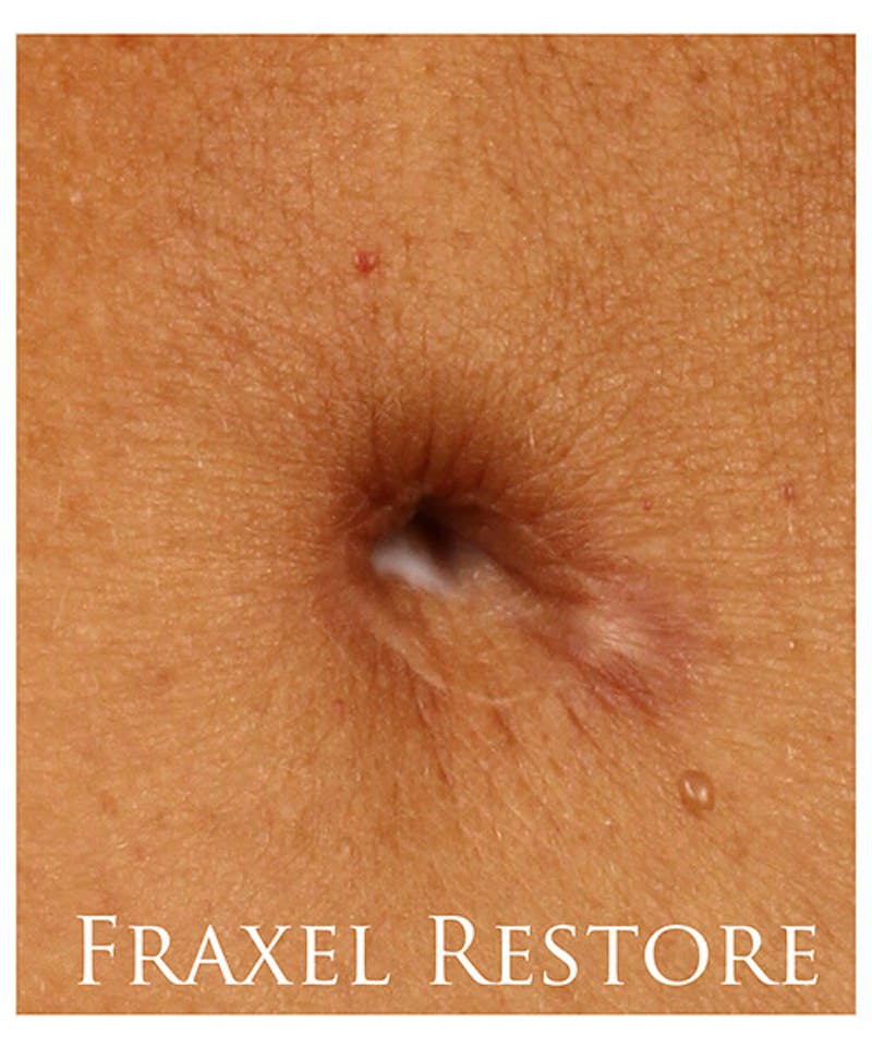 Fraxel Re:store™ Laser Rejuvenation Before & After Gallery - Patient 37499561 - Image 1