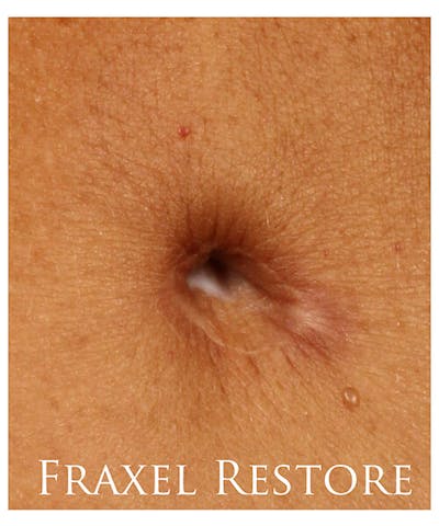 Fraxel Re:store™ Laser Rejuvenation Before & After Gallery - Patient 37499561 - Image 1