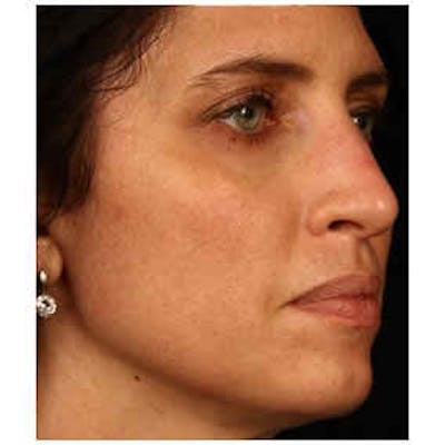 Cosmetic Filler Augmentation Before & After Gallery - Patient 37499564 - Image 1