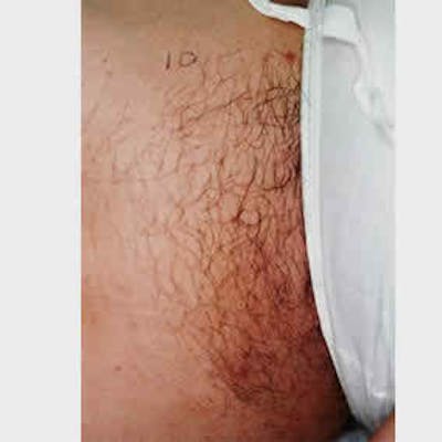 Laser Hair Removal Before & After Gallery - Patient 37499565 - Image 1