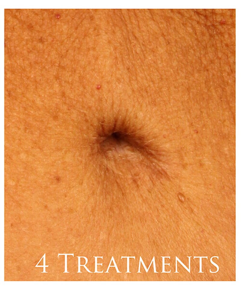 Fraxel Re:store™ Laser Rejuvenation Before & After Gallery - Patient 37499561 - Image 2