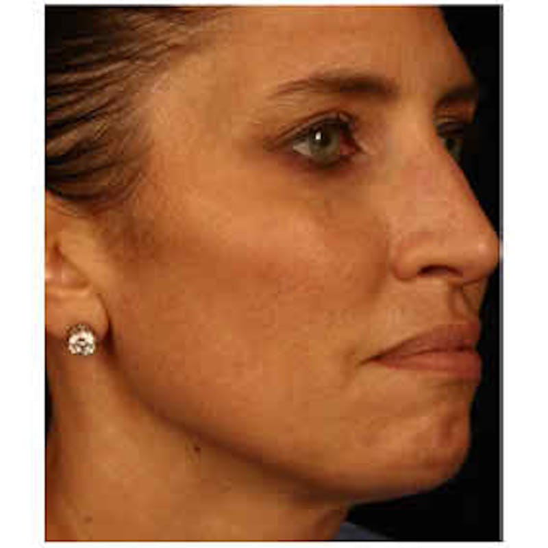 Cosmetic Filler Augmentation Before & After Gallery - Patient 37499564 - Image 2